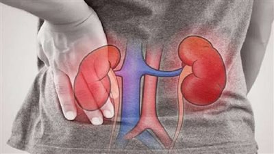 إذا كنت تعاني من حصوات الكلى.. تجنب هذه المشروبات