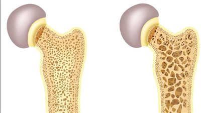 الثلاسيميا: مرض يهدد العظام ويسبب انسداد الشعيرات الدموية
