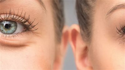 ودّعي تجاعيد العين: الأسباب وطرق العلاج الطبيعية والطبية الفعّالة