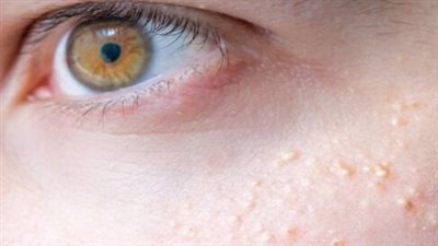 الحبوب تحت العين: الأسباب الشائعة وطرق علاجها الفعالة