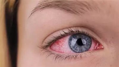 تحذير طبي: جفاف العين قد يكشف مشكلات صحية خطيرة