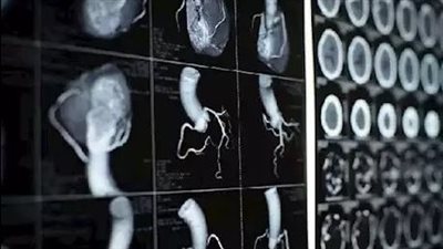 القسطرة أم الأشعة بالصبغة؟.. حسام موافي يوضح الخيار الأفضل لفحص شرايين القلب 