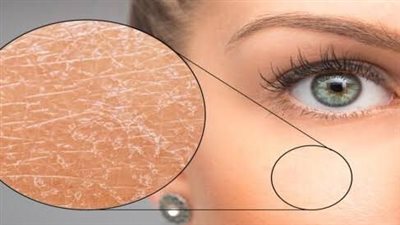 أهم 9 أسباب لجفاف البشرة في الشتاء.. منها الاستحمام بالماء الساخن