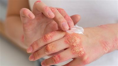 كل ما تريد معرفته عن الصدفية: أسباب ظهورها وأفضل طرق التعامل معها