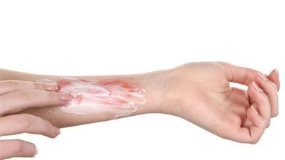 حروق المطبخ الطفيفة.. دليلك للإسعافات الأولية السريعة