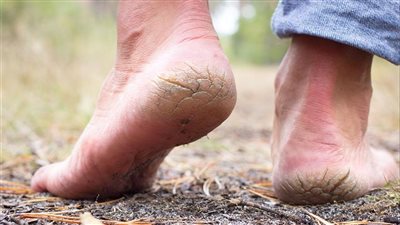 بالعلاجات منزلية.. كيف تعالج تشقق الكعبين؟  