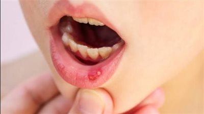 الهربس الفموي المؤلم: طرق فعّالة للعلاج والتخفيف من الأعراض