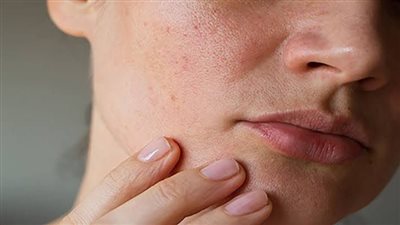 أفضل طرق لعلاج البشرة الجافة والعناية بها للحصول على ترطيب مثالي