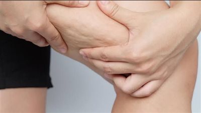 ما هي أسباب ظهور السيلوليت وكيفية علاجه بفعالية؟