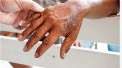 في اليوم العالمي لـ الجذام: خطوات وقائية لحماية نفسك من المرض