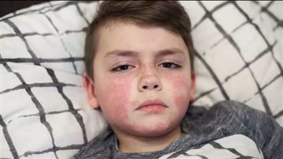 أعراض الحمى القرمزية عند الأطفال وأفضل طرق الوقاية منها