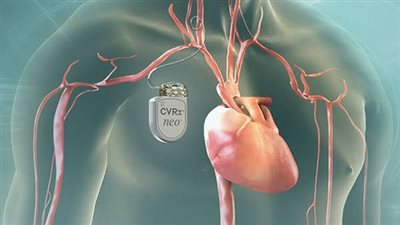 اضطرابات كهرباء القلب: الأسباب والأعراض وطرق الوقاية