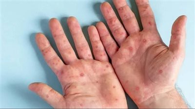 بعد رصدها في الإمارات.. تعرف على أعراض سلالة جدري القرود الجديدة