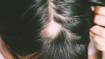 علاجات طبيعية فعالة للحد من تساقط الشعر وعلاج الثعلبة