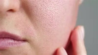 وصفات طبيعية فعّالة للتخلص من المسام المفتوحة.. حلول بسيطة من مطبخك