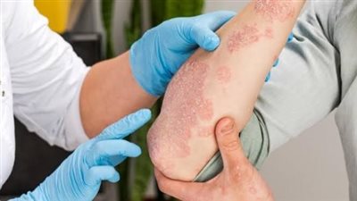 الإكزيما تهاجم الجلد بصمت.. تعرف على أسرارها وطرق السيطرة عليها