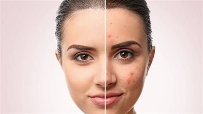 قبل حر الصيف .. روشتة علاج تصبغات البشرة بطرق طبيعية وطبية