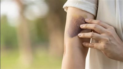كدمات زرقاء تظهر فجأة على الجسم؟.. اكتشف الأسباب الخفية وراءها 