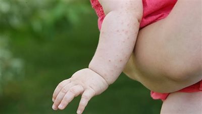 حمو النيل عند الأطفال في الصيف.. نصائح فعالة لحماية بشرة صغيرك الحساسة