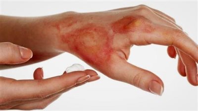 لمريضة السكر.. خطوات آمنة لعلاج حروق المطبخ دون مضاعفات   