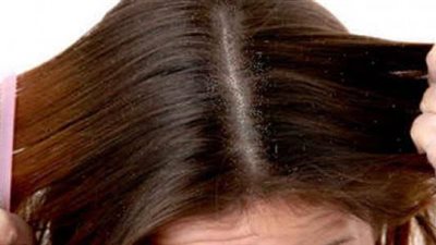 ودعي التساقط للأبد.. 7 حلول مجربة لفروة دهنية صحية