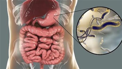 من الانتفاخ إلى الغثيان.. مؤشرات قد تدل على إصابتك بجرثومة المعدة
