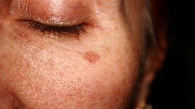 «بقع الشيخوخة تظهر مع العمر».. تعرف على أسبابها وطرق الوقاية الفعالة منها