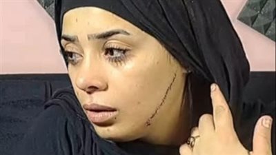 التفاصيل الكاملة حول واقعة تشوية وجه عروسة بـ41 غرزة في مصر القديمة
