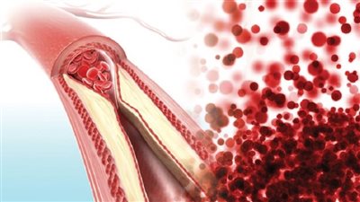 	لا تتجاهلها.. «إشارات مبكرة لانسداد الشرايين»