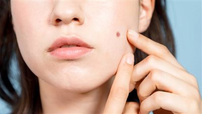 8 طرق فعالة للتغلب على «حب الشباب» للمراهقين