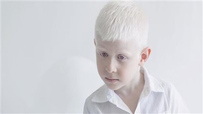تعرف على الأنواع المختلفة لمرض «الألبينو» وأسبابه