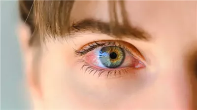 اضطرابات «الغدة الدرقية» تسبب مشكلات خطيرة في الإبصار