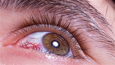 قبل قدوم الشتاء احم عينيك من «الحساسية الموسمية»