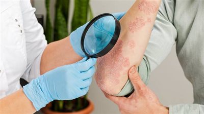 تشققات الصدفية المؤلمة.. هكذا تسيطر عليها بسهولة