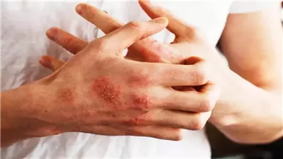 ليست الوراثة فقط المسؤولة.. علامات الإصابة بالصدفية وأسبابها