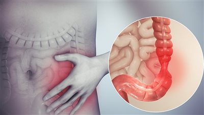 أربع مؤشرات مبكرة خطيرة تكشف خطر سرطان القولون