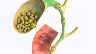 خمسة أعراض تحذيرية تشير لمشكلة محتملة بالمرارة
