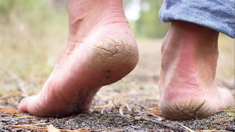 تشققات القدمين