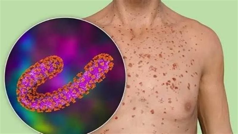 فيروس ماربورج