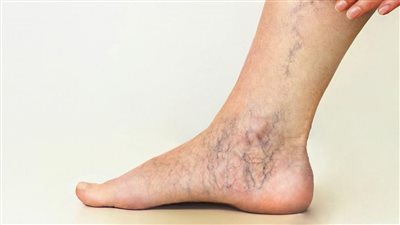 الأكزيما الوريدية.. مضاعفات دوالي الساقين وسبل العلاج