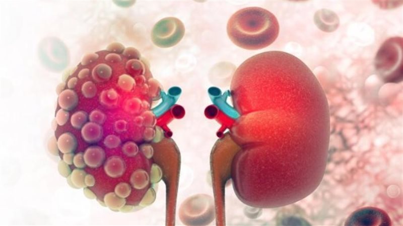 سرطان الكلى 