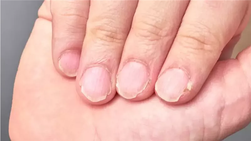  الأظافر الضعيفة